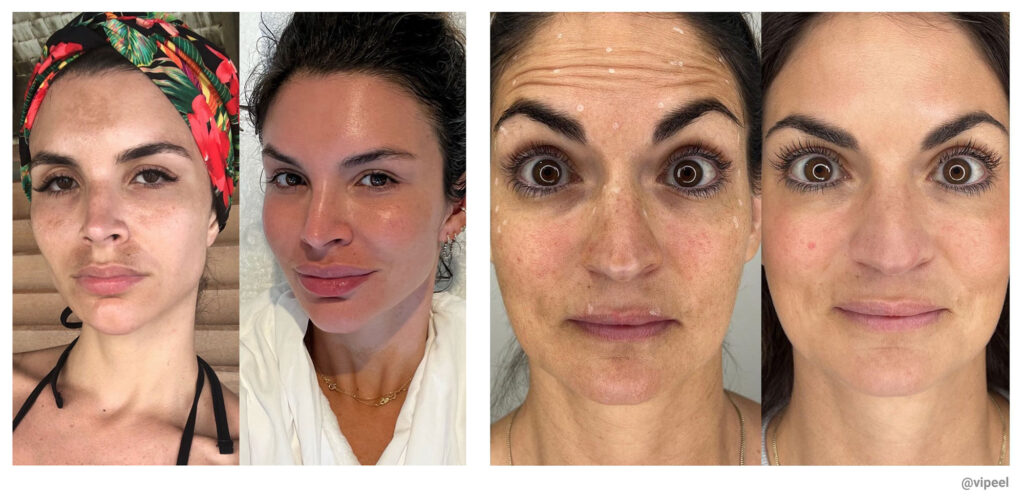 Before and After VI Peel Results